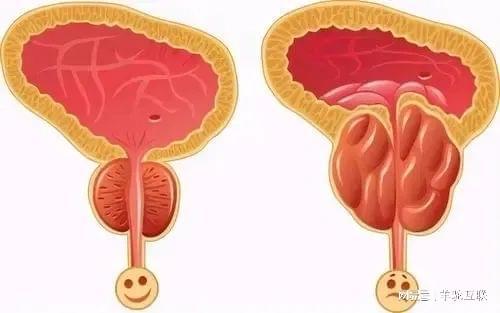 Leyu·乐鱼官网赤峰男科门诊-前列腺炎是怎么引起的(图1)