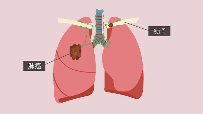 乐鱼体育直面肺癌挑战：全面解析科学防护健康呼吸(图3)